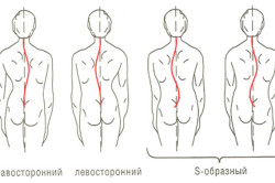 Лікування хребта в домашніх умовах як виправити сколіоз, витягування хребта, робота з