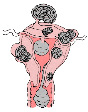Leiomul uterului este intramural, submucos, subseros