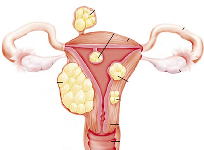 Leiomul uterului este intramural, submucos, subseros