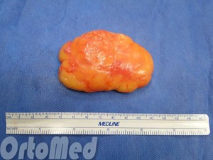 Lipoma (zhirovki) okoz, kezelése a tünetek, a művelet eltávolítása módjai lipómák (ok) Lipoma (zhirovki) okoz, kezelése a tünetek, a művelet eltávolítása módjai lipóma