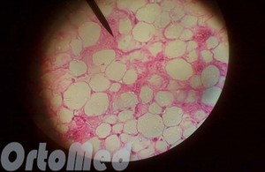 Lipoma (zhirovki) okoz, kezelése a tünetek, a művelet eltávolítása módjai lipómák (tünetek) Lipoma (zhirovki) okoz, kezelése a tünetek, a művelet eltávolítása módjai lipóma