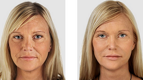 Facial masaj de drenaj limfatic este mai bun decât un bisturiu, este mai util decât Botox