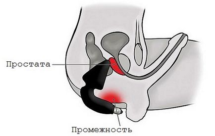 Masajul prostatei cu plus și minus adenom prostatic