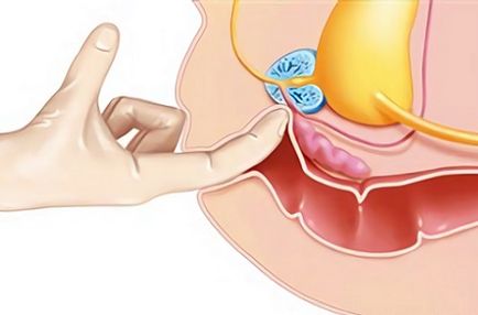 Masajul prostatei cu plus și minus adenom prostatic