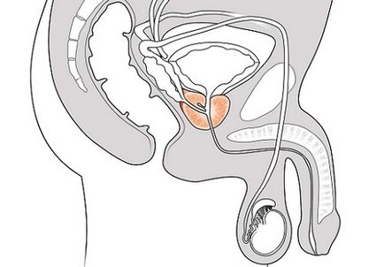 Masajul prostatei cu plus și minus adenom prostatic