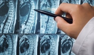 Metastaze osoase în cancerul de prostată