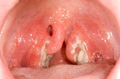 Наскільки небезпечно наявність казеозних пробок у горлі