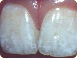 Недороге, якісне лікування флюорозу зубів у москві