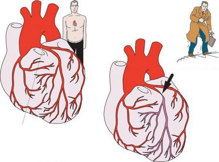 Instabil angina pectoris - besorolás, tünetei és kezelése