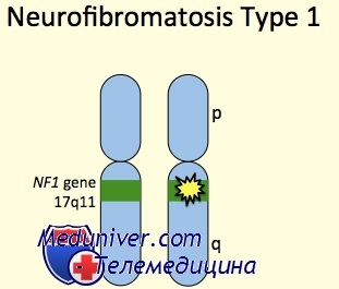 Neurofibromatoza - cauze, epidemiologie, clinica