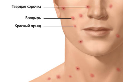 Дали варицелата опасно или е скрит под малък обрив