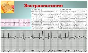 Чи небезпечні надшлуночкові екстрасистоли і яка їх норма