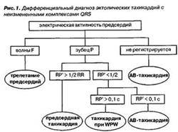 Опасно ли е да суправентрикуларна аритмия и как те оценяват