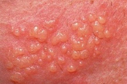 Herpes zoster tünetei és kezelése Felnőttek