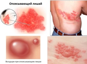 Tinea este infecțioasă - o lipsă caracteristică și căi de infectare