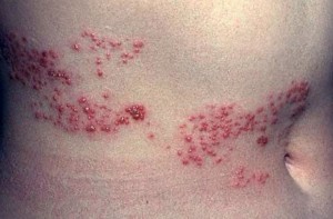 Tinea este infecțioasă - o lipsă caracteristică și căi de infectare