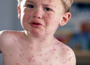 Tinea este infecțioasă - o lipsă caracteristică și căi de infectare