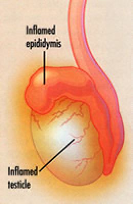 Umflarea testiculelor, copilul a umflat testiculul drept, din care se umflă ouăle