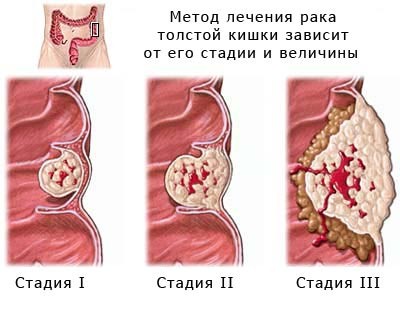 Tumoarea rectului