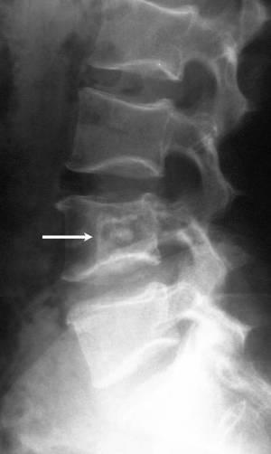 Osteomul este o tumoare osoasă benignă