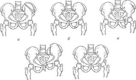 Fractură a simptomelor pelvisului, diagnostic, tratament, pune în pericol viața