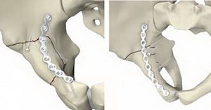 Fractură a simptomelor pelvisului, diagnostic, tratament, pune în pericol viața