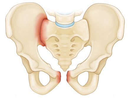 Fractură a simptomelor pelvisului, diagnostic, tratament, pune în pericol viața