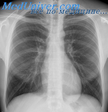 Pericardial și pericardic pe radiografie