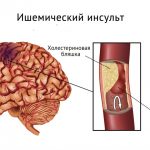 Prevenirea primară și secundară a accidentului cerebral la bărbați, femei și copii ca