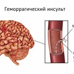 Az elsődleges és másodlagos megelőzés agyi stroke férfiak, nők és gyermekek, mint a