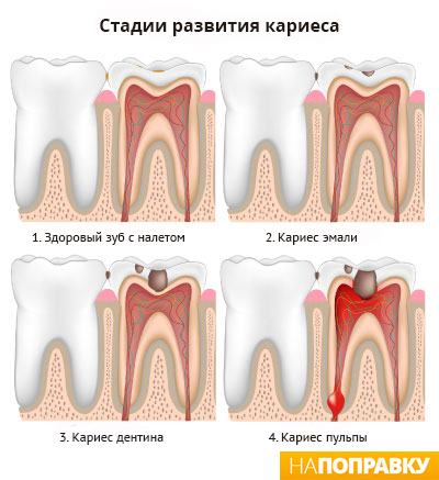 Пломбування зубів (зубних каналів) загальні відомості і догляд - напоправку