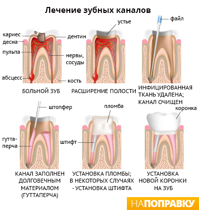 Umplerea dinților (canale dentare) informații generale și îngrijire - expediere