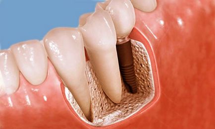 Előállítás fogászati ​​implantátumok, hogy meg kell tenni a műtét előtt