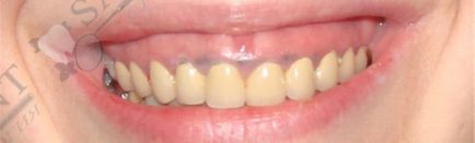 Guma devine albastră după extracția dintelui, ce să facă cu gingiile albastre