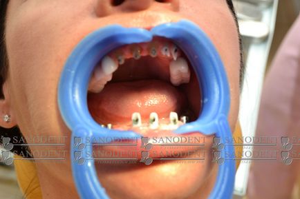 Guma devine albastră după extracția dintelui, ce să facă cu gingiile albastre