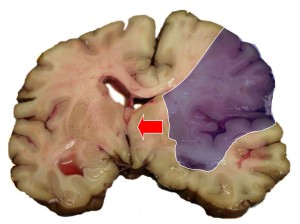 Semne și simptome de accident vascular cerebral repetate