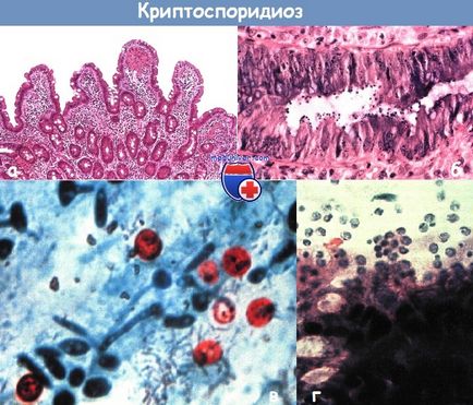 Cauzele și clinica de criptosporidioză