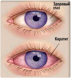 Cauzele și tratamentul ochilor roșii la un copil - boli posibile