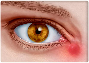 Причини і лікування червоних очей у дитини - можливі захворювання