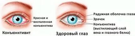 Cauzele și tratamentul ochilor roșii la un copil - boli posibile