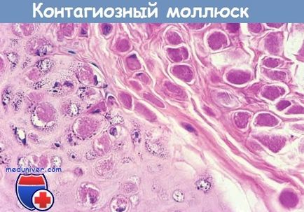 Cauzele și mecanismele de dezvoltare a contagiosum molluscum