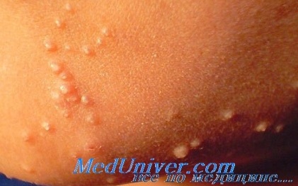 Cauzele și mecanismele de dezvoltare a contagiosum molluscum