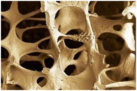 Застосування Тяньши при остеопорозі, як запобігти остеопороз у жінок з Тяньши