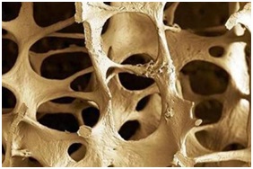 Az alkalmazás Tiens osteoporosis, hogyan lehet megelőzni a csontritkulás nőknél Tianshi