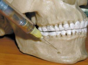 Efectuarea anesteziei în stomatologie - ce este, tipul, video - dinte medic