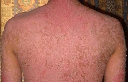 Psoriasis 5 valósághű történetét (a kezelés után a pikkelysömör) Psoriasis 5 őszinte története