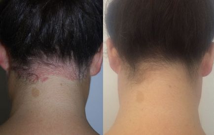 Psoriasis 5 valósághű történetét (a kezelés után a pikkelysömör) Psoriasis 5 őszinte története