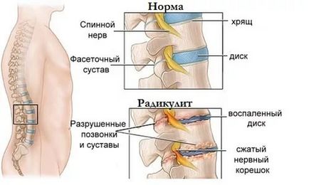 Radiculita în timpul sarcinii cauzează, simptome, tratament