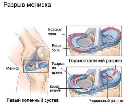 Розтягнення зв'язок колінного суглоба лікування в домашніх умовах