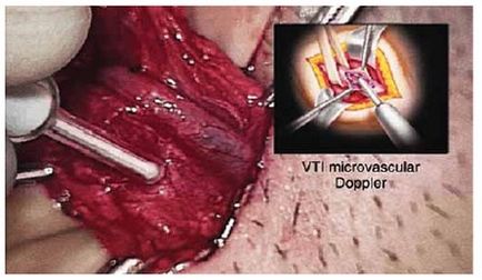 Kiújulásának varicocele modern megjelenés, urológia ma